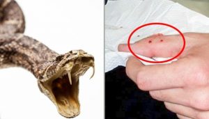 Biểu hiện khi bị rắn độc cắn sẽ như thế nào?